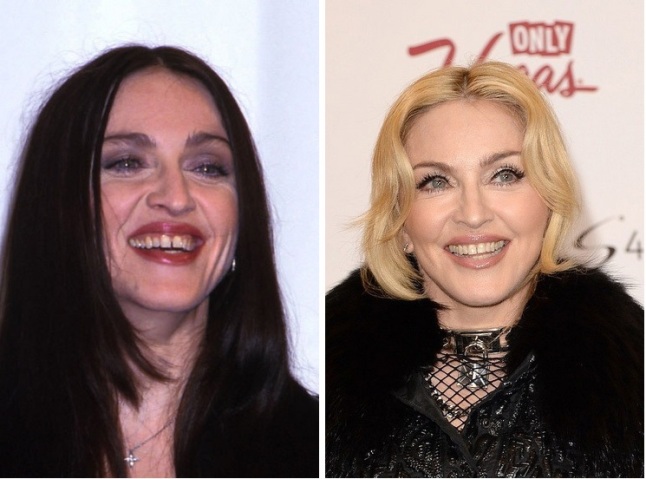 madonna dentes