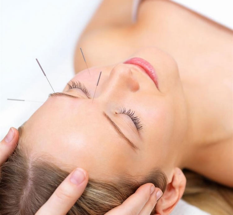 acupuntura-para-remover-rugas