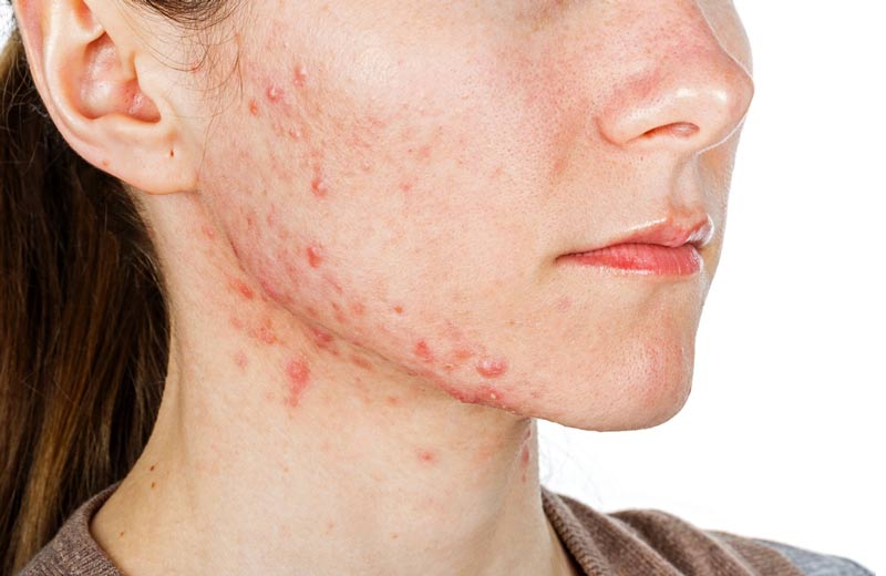 Síndrome-dos-ovários-policísticos-acne-hormonal-adulta