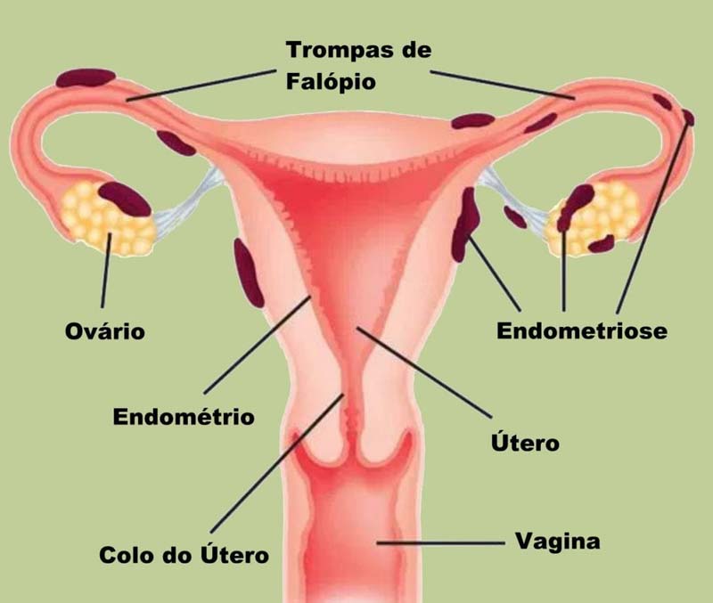 endometriose-o-que-e-quais-sintomas-tem-tratamento-2
