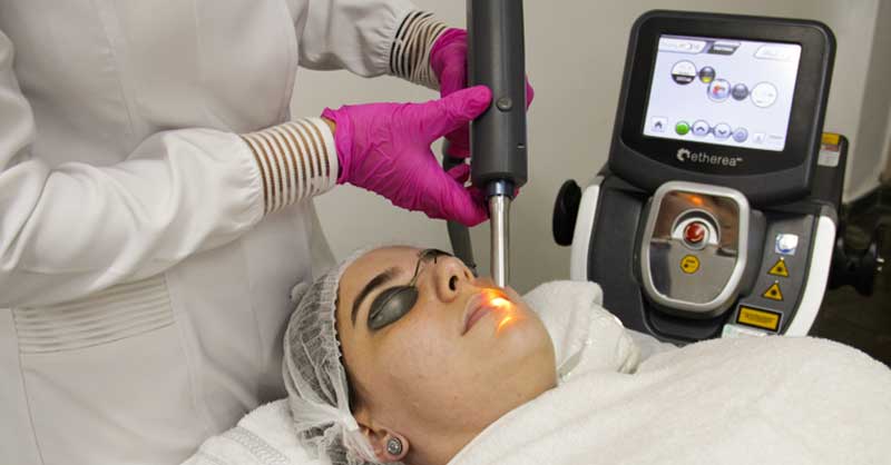 Laser resurfacing nos labios