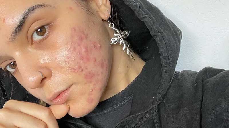 acne severa no rosto como tratar
