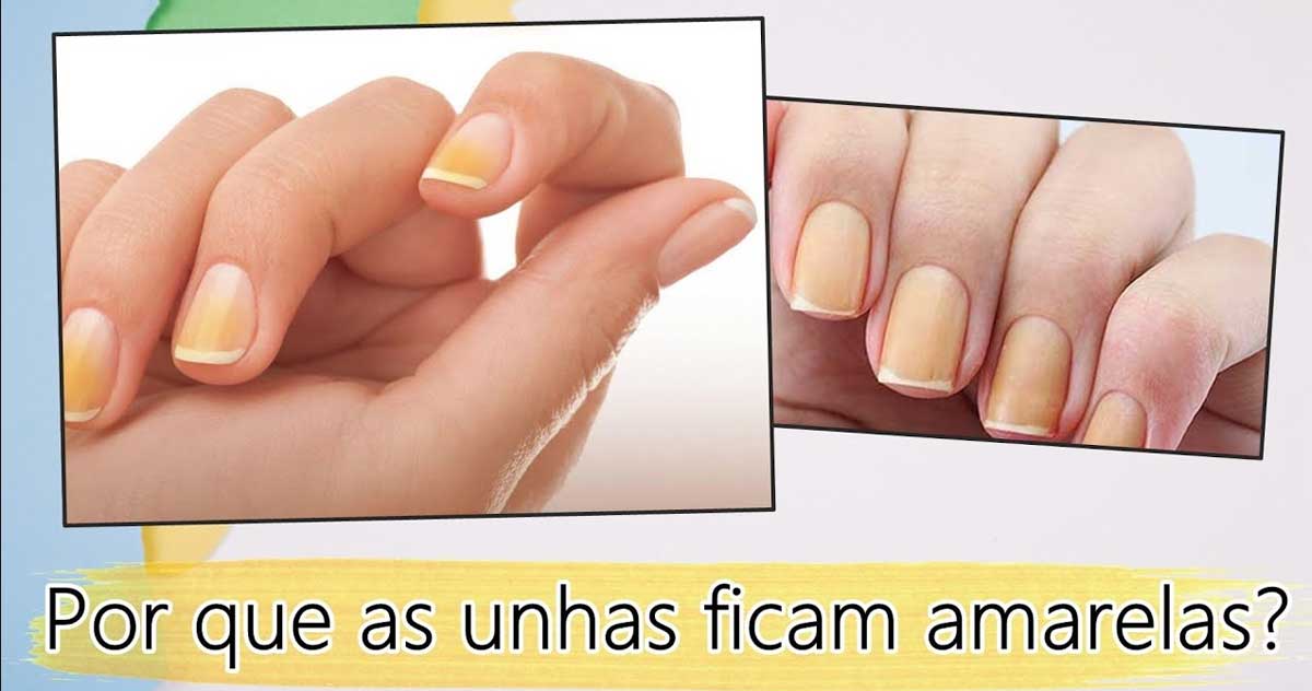 Unhas amarelas